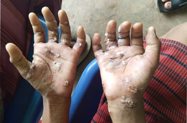 မကွေး၊ တနင်္သာရီနှင့် ကရင်နီမှ စစ်ဘေးရှောင်အများအပြား အရေပြား ဝဲရောဂါ ဆိုးဝါးစွာ ခံစားနေရ   သတင်းနှင့် မီဒီယာ ကွန်ရက်။ ၂၀၂၆ ခုနှစ်၊ ဖေဖော်ဝါရီလ ၃ ရက်။   မကွေး၊ တနင်္သာရီနှင့် ကရင်နီတို့တွင် ရေရှားပါးမှုနှင့် ဆေးဝါးပိတ်ဆို့မှုကြား စစ်ဘေးရှောင်ထောင်ချီ အရေပြား ယားနာ ဝေဒနာကို ဆိုးဝါးစွာ ခံစားနေရသည်ဟု မြေပြင်ကူညီပေးရေးအဖွဲ့များက ပြောသည်။   နိုင်ငံအနှံ့အပြားရှိ စစ်ဘေးရှောင်စခန်းများတွင် သန့်ရှင်းသော သောက်သုံးရေ ရှားပါးလာမှုနှင့်အတူ အရေပြား ရောဂါများ ကူးစက်ပြန့်ပွားမှု ဆိုးဝါးနေပြီး စစ်ကော်မရှင်၏ ဆေးဝါးသယ်ယူခွင့် တင်းကျပ်ပိတ်ဆို့ထားမှုများ ကြောင့် အရေးပေါ်ဆေးဝါးကူညီမှုများ လိုအပ်နေသည်ဟု အကူအညီပေးနေသူများက ပြောသည်။   အထူးသဖြင့် မကွေးတိုင်း ပေါက်မြို့နယ်တွင် စစ်ဘေးရှောင် ၁,၀၀၀ ခန့်နှင့် စလင်းမြို့နယ်တွင် ဇန်နဝါရီလ တတိယပတ်မှစ၍ တိမ်းရှောင်နေရသည့် ဒေသခံ ၈,၀၀၀ ကျော်သည် ရေရှားပါးမှုဒဏ်နှင့်အတူ အရေပြားရောဂါ ကို ဆိုးဆိုးရွားရွား ကြုံတွေ့နေရသည်။   ပေါက်မြို့နယ် ဇုန် (၁) နယ်မြေအတွင်းမှာ ကာလရှည်ကြာ နေရပ်စွန့်ခွာ တိမ်းရှောင်နေရတဲ့ စစ်ဘေးရှောင်ပြည် သူ ၁,၀၀၀ ဝန်းကျင်မှာ အရေပြားရောဂါဝေဒနာကို ဆိုးဆိုးရွားရွား ခံစားနေရသည်ဟု လူသားချင်း စာနာထောက် ထားရေးနှင့် ဘေးအန္တရာယ်ဆိုင်ရာ စီမံခန့်ခွဲရေးဌာန ပေါက်မြို့က ဇန်နဝါရီလ ၂၆ ရက်နေ့တွင် ထုတ်ပြန်ထား သည်။   အလားတူ တနင်္သာရီတိုင်းထဲတွင်လည်း စစ်ဘေးရှောင်များ အရေပြားယားနာရောဂါ ဖြစ်ပွားနေသည်ဟု တနင်္သာရီ - စစ်ဘေးရှောင်များ အထောက်အကူပြုရေးအဖွဲ့က ပြောသည်။   ဒေါန တနင်္သာရီ-စစ်ဘေးရှောင်များ အထောက် အကူ ပြုရေးအဖွဲ့ မြေပြင်တာဝန်ခံ ကိုယောနသံက “အဓိက တစ်ကိုယ်ရည် သန့်ရှင်းမှုအားနည်းတာ၊ သောက် သုံးရေ သုံးစွဲနေတဲ့ ရေအရင်းမြစ်မှာလည်း မသန့်ရှင်းမှု ကြောင့်လည်း ပါတယ်ပေါ့နော်။ ပြီးတော့ လုံလောက်တဲ့ ဆေးဝါးကုသမှု မရရှိတာတွေလည်း ပါတယ်။ ဒီလို မျိုး အကြောင်းအရာတွေကြောင့် အရေပြား ယာနာ ဖြစ်ပွား တယ်။ ဖြစ်ပွားလာလို့ရှိရင်လည်း စနစ်တကျ မကုသနိုင်ဘဲနဲ့ ပိုပြီးတော့ ဖြစ်ပွားမှုတွေများလာတယ် အမြစ် မပြတ်ဘဲ ဖြစ်နေတယ်ဆိုတဲ့ အနေအထားနဲ့ ကြုံရတာပေါ့နော်” ဟု ပြောသည်။   ကရင်နီပြည်၊ ရှားတောမြို့နယ်ရှိ စစ်ဘေးရှောင်စခန်းများတွင်လည်း ဇန်နဝါရီလအတွင်း အရေပြားရောဂါ ဖြစ်ပွားသူ ၄၀ ကျော်ရှိခဲ့ပြီး အများစုမှာ အသက် ၁၅ နှစ်အောက် ကလေးငယ်များ ဖြစ်နေသည်ဟု အရေးပေါ် ကယ်ဆယ်ရေး၊ ညှိနှိုင်းရေးအဖွဲ့ (ကရင်နီ) CTER-Karenni က ဖေဖော်ဝါရီလ ၂ ရက်နေ့က ထုတ်ပြန်ထားသည်။   CDM ဆရာဝန်များ၏ အဆိုအရ ယခုဖြစ်ပွားနေသည့် လက္ခဏာများသည် ကူးစက်မှုမြန်ဆန်လှသည့် ‘ဝဲရောဂါ (Scabies)’ ဖြစ်ပြီး ထိတွေ့ဆက်ဆံသူ အားလုံးကို တစ်ပြိုင်တည်း ကုသပေးနိုင်မှသာ ထိန်းချုပ်နိုင်မည်ဟု ဆိုသည်။   သို့သော် စစ်ကော်မရှင်၏ ‘ဖြတ်လေးဖြတ်’ မူဝါဒကြောင့် ဆေးဝါးသယ်ယူခွင့်များ ပိတ်ဆို့ခံထားရခြင်းက အဓိက အဟန့်အတား ဖြစ်နေသည်။   အဆိုပါ အခြေအနေနှင့် ပတ်သက်၍ ကိုယောနသံက “စစ်တပ်က ဖြတ်လေးဖြတ် လုပ်ပြီးတော့ ဆေးဝါး သယ် ယူခွင့်တွေကို ပြင်းပြင်းထန်ထန်နဲ့ တင်းတင်းကျပ်ကျပ် တားမြစ်ထားတာတွေ ရှိတယ်။ လက်ရှိမှာက ကုန်ဈေး နှုန်းလည်း မြှင့်တက်နေတဲ့ အနေအထားမှာ ဆေးဝါးတွေကို ခိုးဝှက်ပြီးတော့ သယ်ရတဲ့ အနေအထား ဆိုတော့ ဆေးဝါးတွေက အဆမတန်‌ဈေးမြင့်သွားတဲ့ အနေအထားရှိတယ်” ဟု ပြောသည်။     လက်ရှိတွင် ပဋိပက္ခဒေသများ၌ ပိုးသတ်ဆေးလိမ်းဆေးများနှင့် ယားယံခြင်းကို လျှော့ချပေးသည့် အရေးပေါ် ဆေးဝါးများ ပြတ်လပ်နေသည်။   အဆိုပါ အရေပြားရောဂါသည် တနင်္သာရီတိုင်းအတွင်း ဖြစ်ပွားနေသည်မှာ တစ်နှစ်ကျော်ရှိပြီ ဖြစ်သော်လည်း ဆေးဝါးရှားပါးမှုနှင့် တစ်ကိုယ်ရေသန့်ရှင်းရေး အခက်အခဲများကြောင့် ယနေ့တိုင် အမြစ်ပြတ်အောင် မကုသနိုင် ဘဲ ရှိနေကြောင်း အကူအညီပေးနေသူများက ပြောသည်။   ဓါတ်ပုံ - လူသားချင်း စာနာထောက်ထားရေးနှင့် ဘေးန္တာရာယ်ဆိုင်ရာ စီမံခန့်ခွဲရေးဌာန ပေါက်မြို့/CTER-Karenni  